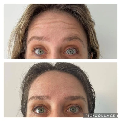 vivadent_antesdepois