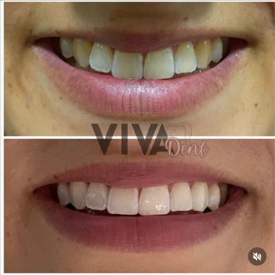 vivadent_antesdepois_10