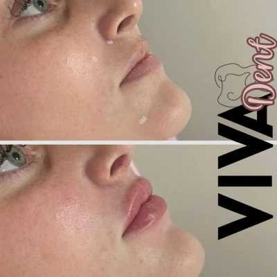 vivadent_antesdepois_11