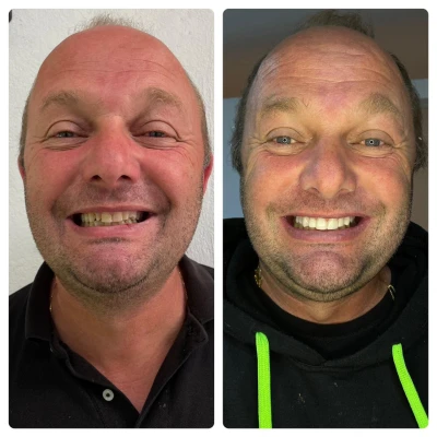 vivadent_antesdepois_3