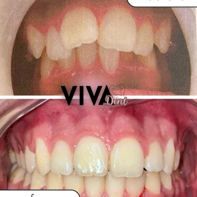 vivadent_antesdepois_6