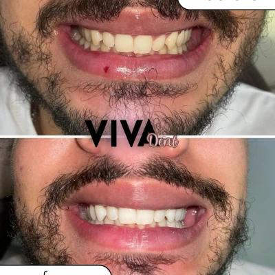 vivadent_antesdepois_7