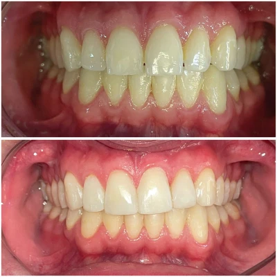 vivadent_antesdepois_8